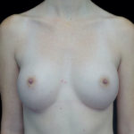 Breast Augmentation (Implants) Before & After Patient #18681