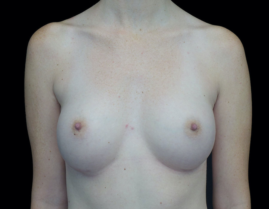 Breast Augmentation (Implants) Before & After Patient #18681