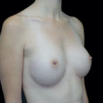 Breast Augmentation (Implants) Before & After Patient #18681