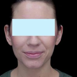 Otoplasty Before & After Patient #18717