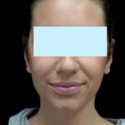 Otoplasty Before & After Patient #18717