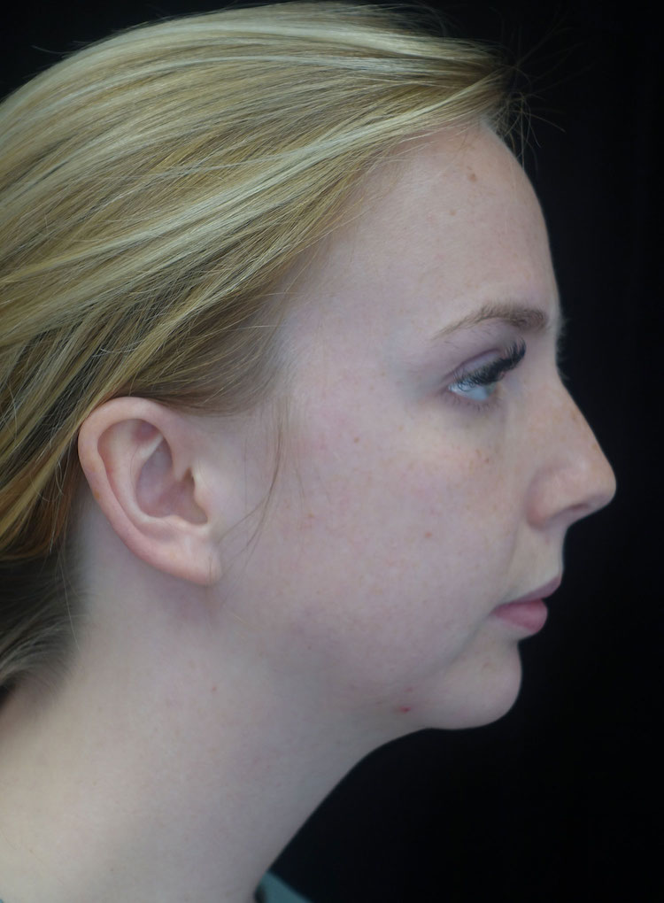 Chin Implants (Augmentation) Before & After Patient #18756