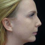 Chin Implants (Augmentation) Before & After Patient #18756