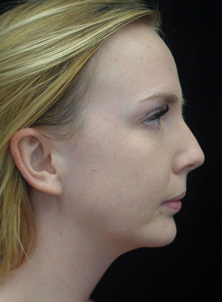 Chin Implants (Augmentation) Before & After Patient #18756