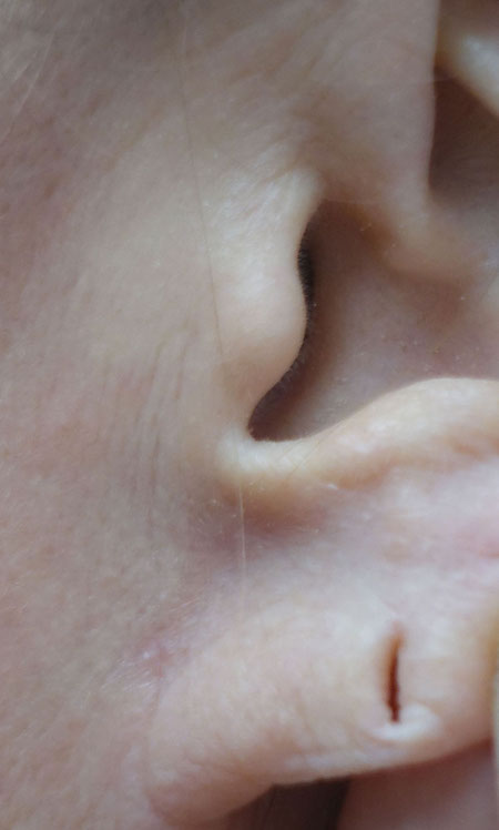 Earlobe Repair Before & After Patient #18743