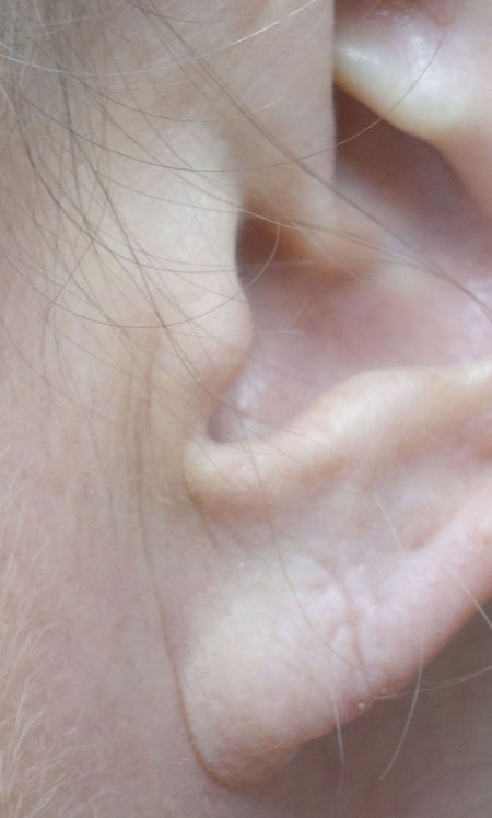 Earlobe Repair Before & After Patient #18743