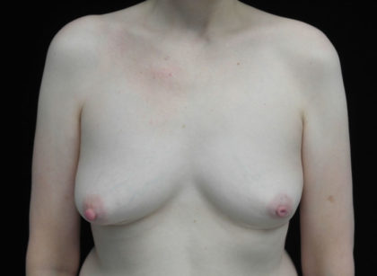Breast Augmentation (Fat Transfer) Before & After Patient #18730