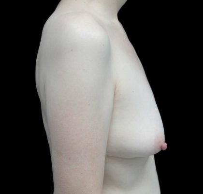 Breast Augmentation (Fat Transfer) Before & After Patient #18730