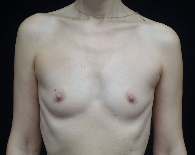 Breast Augmentation (Fat Transfer) Before & After Patient #18748