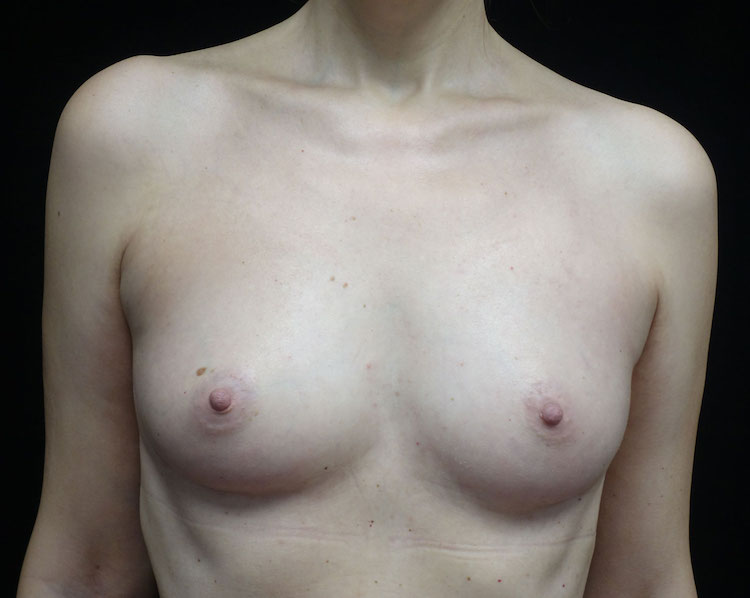 Breast Augmentation (Fat Transfer) Before & After Patient #18748