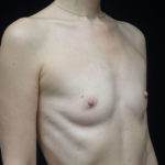 Breast Augmentation (Fat Transfer) Before & After Patient #18748