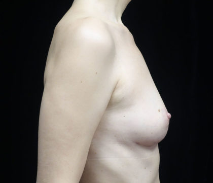 Breast Augmentation (Fat Transfer) Before & After Patient #18748