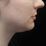 Kybella Before & After Patient #18738