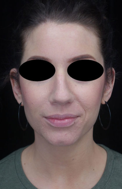 Otoplasty Before & After Patient #18717