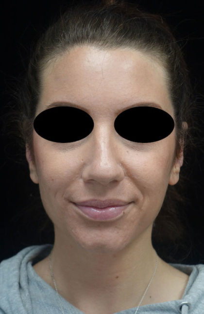 Otoplasty Before & After Patient #18717