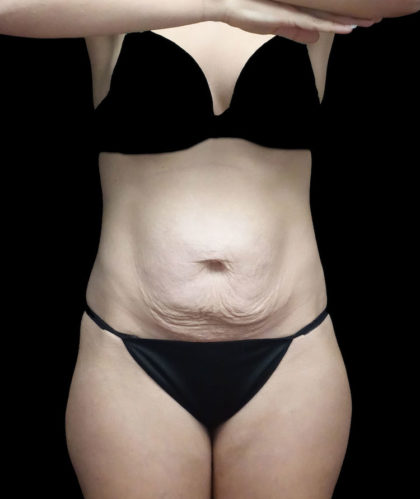 Tummy Tuck Before & After Patient #18723