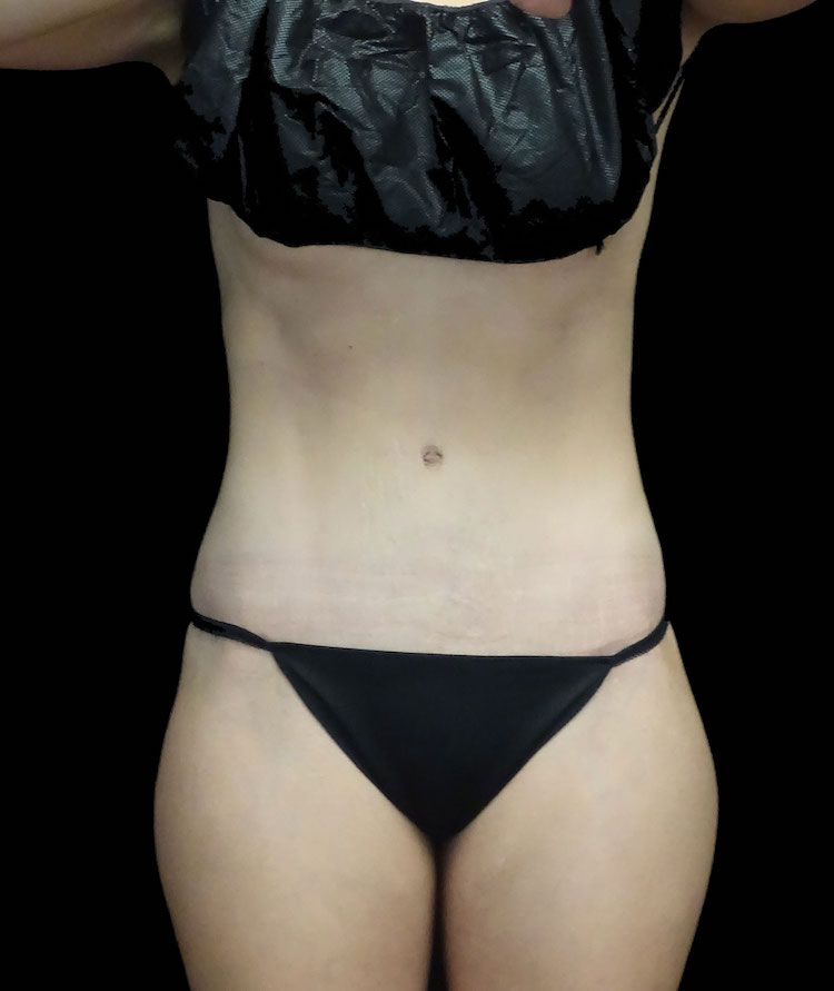 Tummy Tuck Before & After Patient #18723