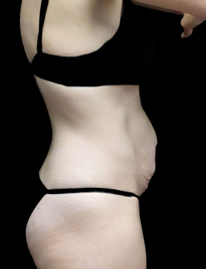 Tummy Tuck Before & After Patient #18723