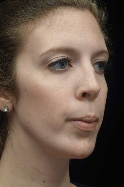 Chin Implants Before & After Patient #18819