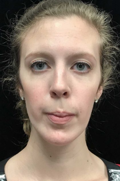 Chin Implants Before & After Patient #18819