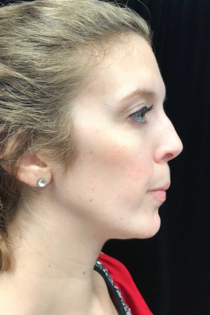 Chin Implants Before & After Patient #18819