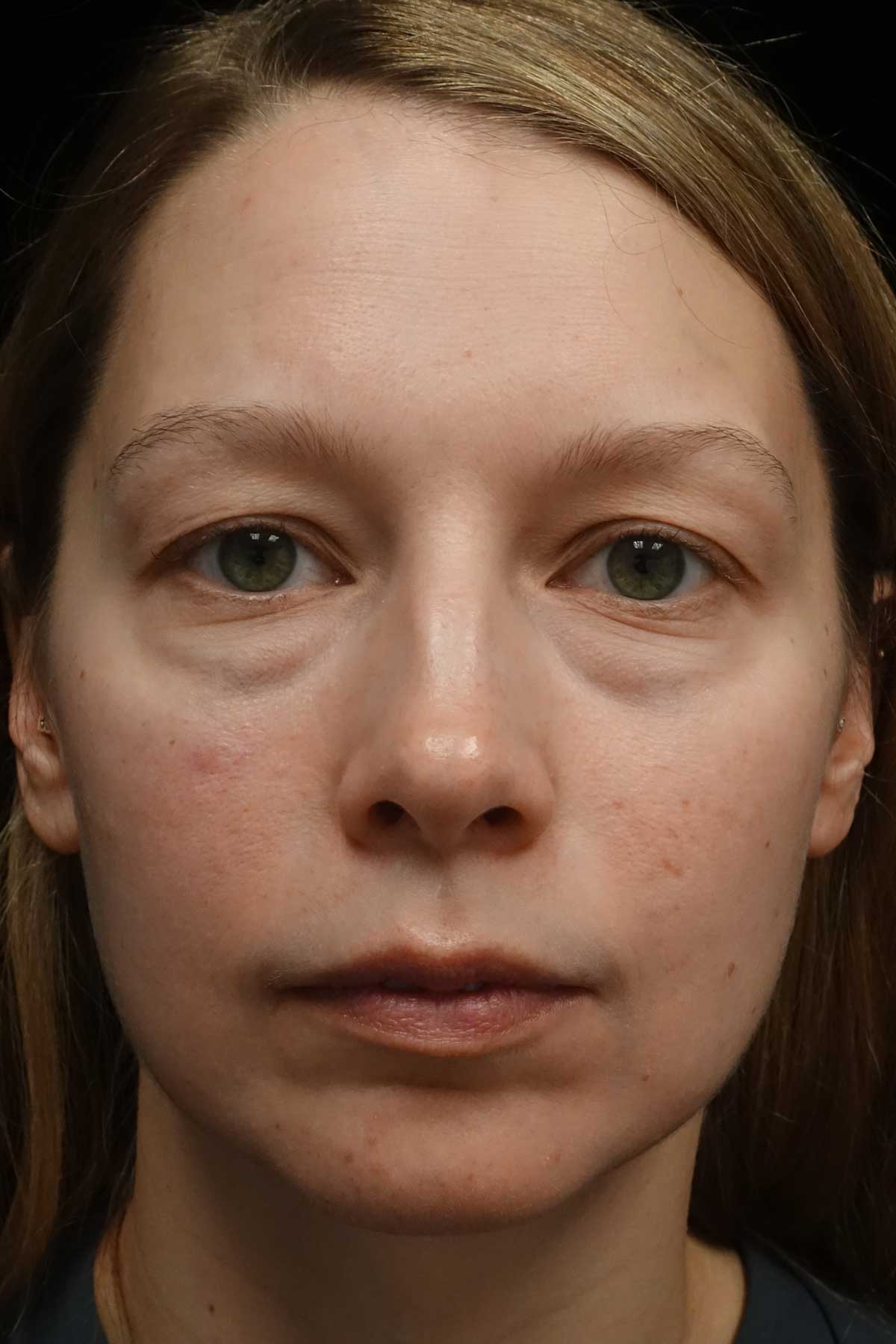 Blepharoplasty Before & After Patient #18805