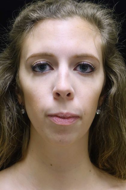 Chin Implants Before & After Patient #18819