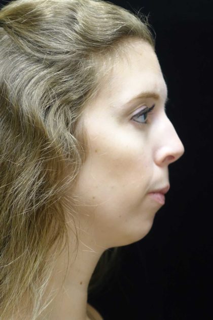Chin Implants Before & After Patient #18819