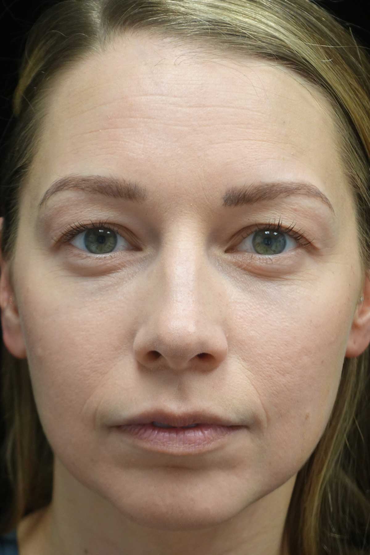 Blepharoplasty Before & After Patient #18805