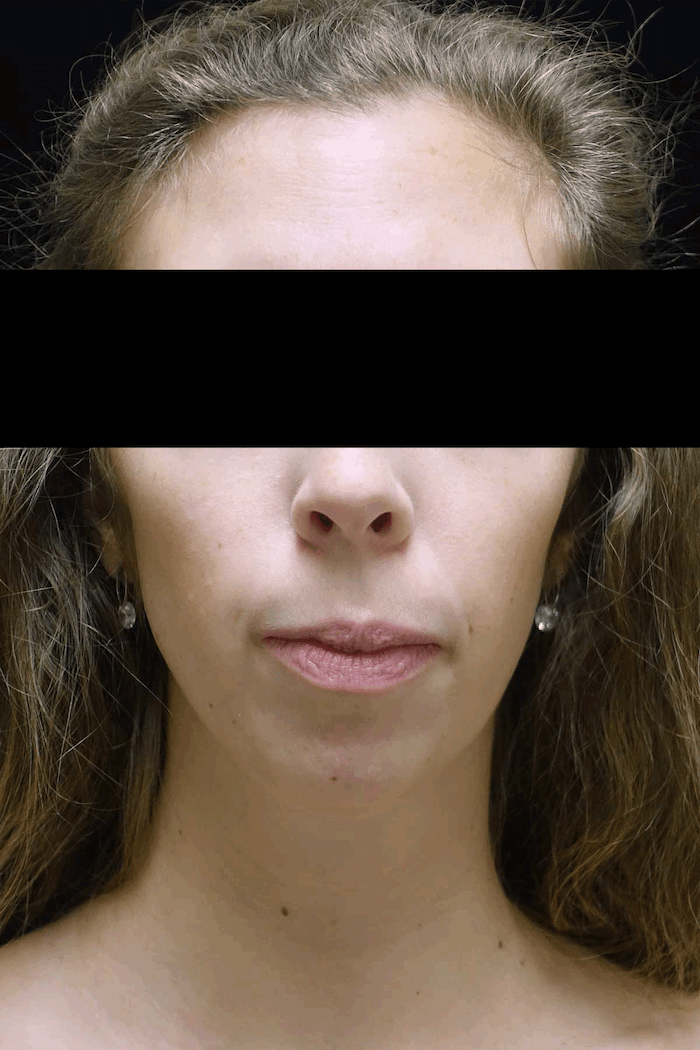 Chin Implants (Augmentation) Before & After Patient #18819