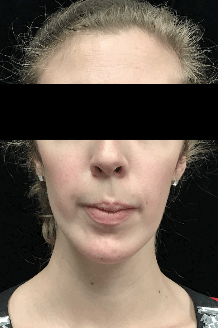 Chin Implants (Augmentation) Before & After Patient #18819