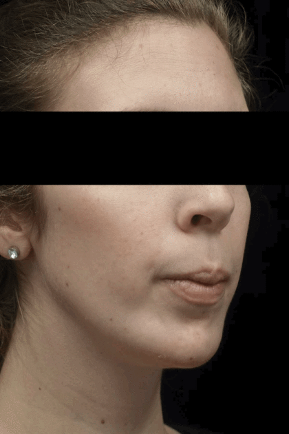 Chin Implants (Augmentation) Before & After Patient #18819