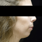 Chin Implants (Augmentation) Before & After Patient #18819