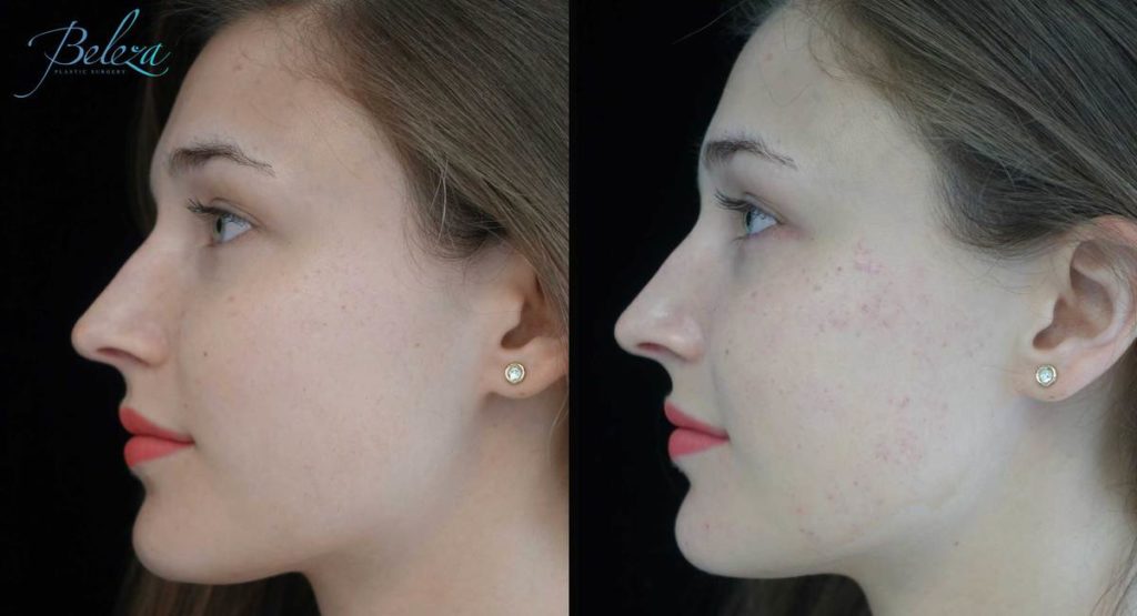 Intense Pulse Light Treatment Pittsburgh Before and After