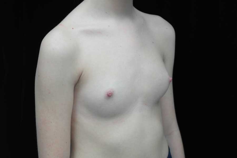 Breast Augmentation (Implants) Before & After Patient #18942