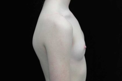 Breast Augmentation (Implants) Before & After Patient #18942