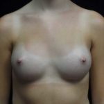 Breast Augmentation (Implants) Before & After Patient #18942