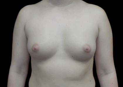 Breast Augmentation (Implants) Before & After Patient #18950