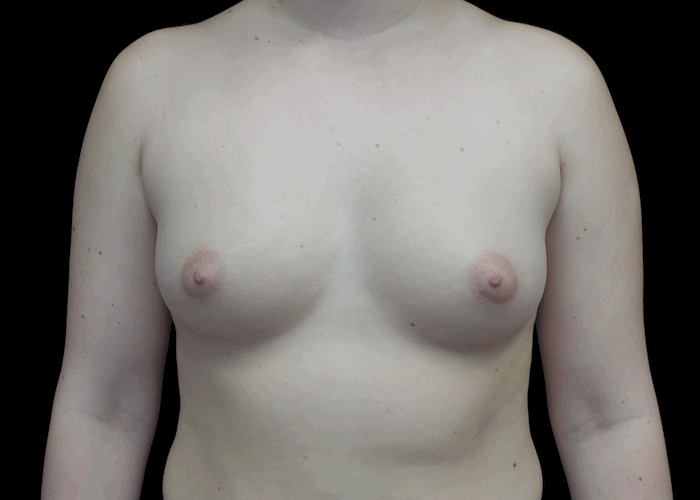 Breast Augmentation (Implants) Before & After Patient #18950