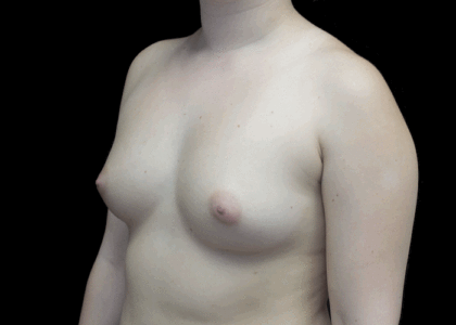 Breast Augmentation (Implants) Before & After Patient #18950