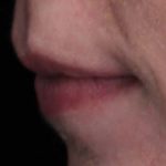 Lip Augmentation - Fillers Before & After Patient #18968