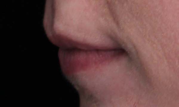 Lip Augmentation - Fillers Before & After Patient #18968