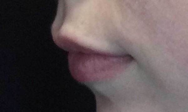 Lip Augmentation - Fillers Before & After Patient #18968