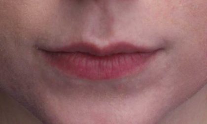 Lip Augmentation - Fillers Before & After Patient #18968