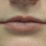 Lip Augmentation - Fillers Before & After Patient #18961