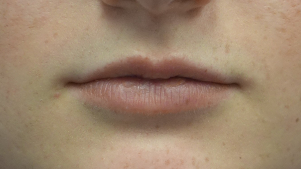 Lip Augmentation - Fillers Before & After Patient #18961
