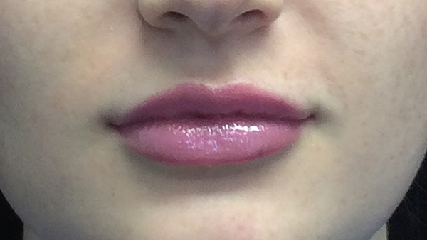 Lip Augmentation - Fillers Before & After Patient #18961