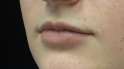 Lip Augmentation - Fillers Before & After Patient #18961