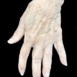 Fat Transfer to Hands Before & After Patient #18991