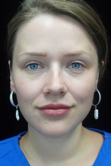 RHA Fillers Before & After Patient #19035